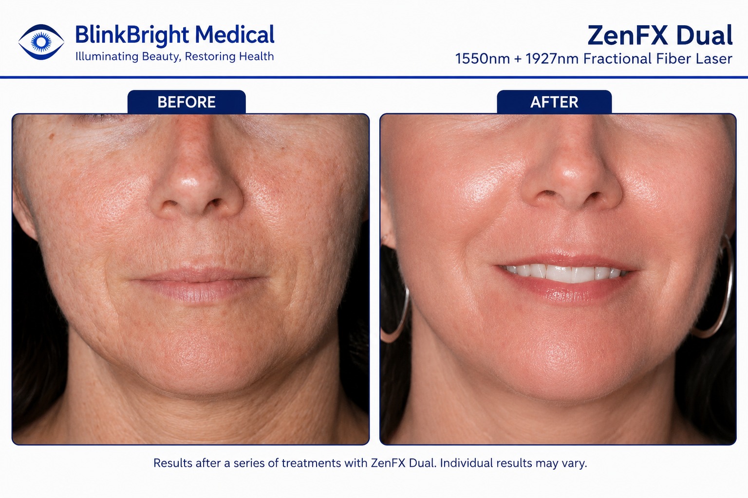 Skin Texture & Pores Rejuvenation