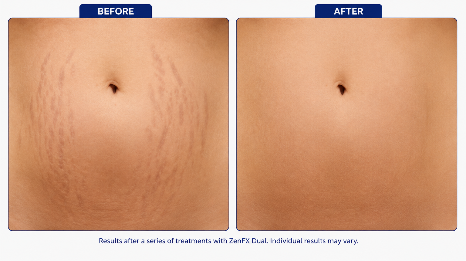 Skin Texture & Pores Rejuvenation