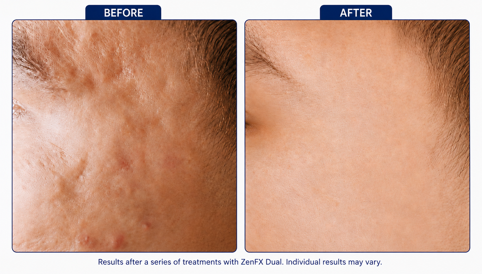 Dermal Striae Stretch Mark Revision