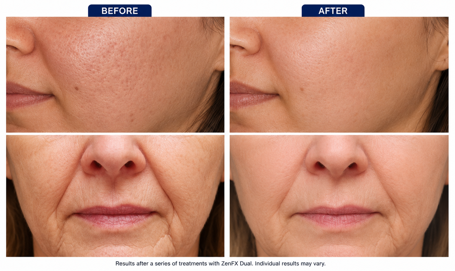Rhytids & Photoaging Reversal