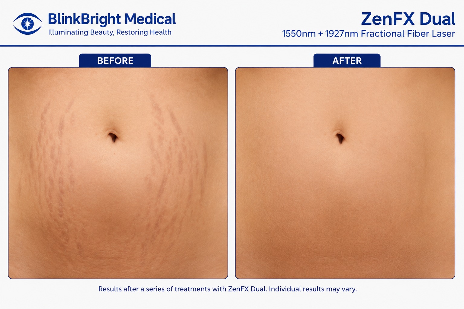 Late-Stage Dermal Striae Management