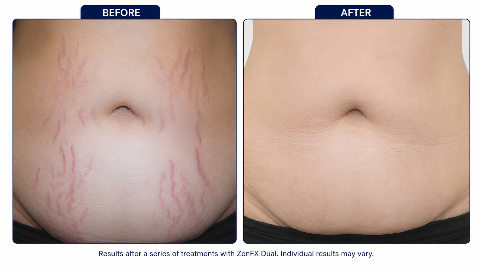 Late-Stage Dermal Striae Management