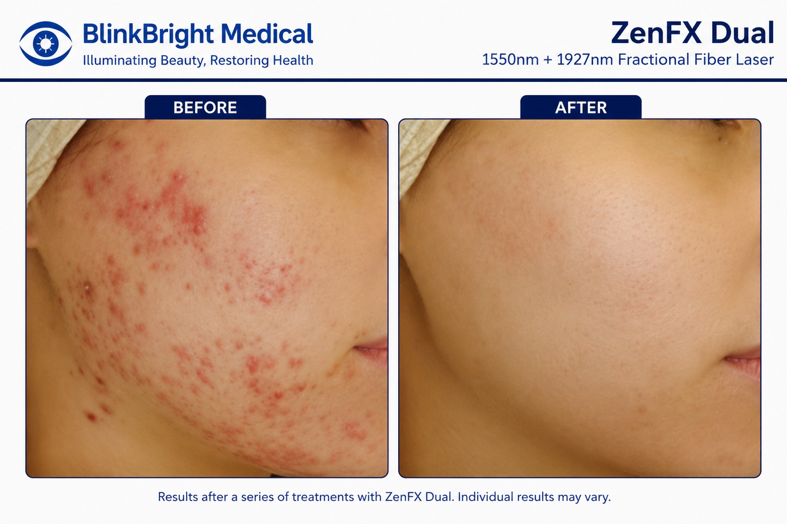 Melasma & Pigmentation Tone Clarification
